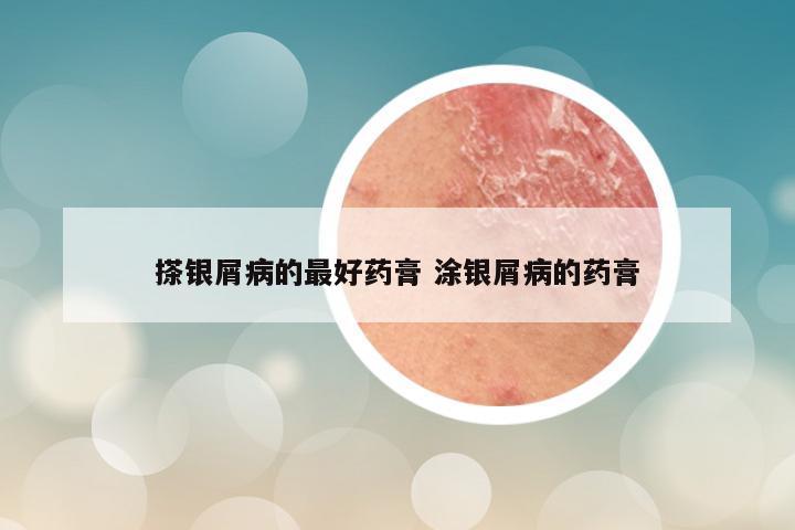 搽银屑病的最好药膏 涂银屑病的药膏