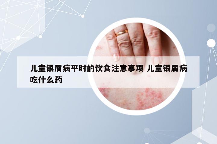 儿童银屑病平时的饮食注意事项 儿童银屑病吃什么药