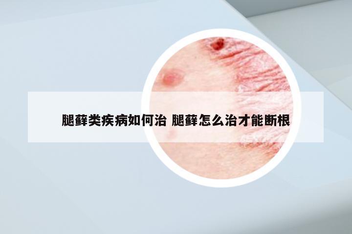 腿藓类疾病如何治 腿藓怎么治才能断根