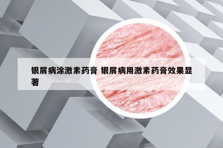 银屑病涂激素药膏 银屑病用激素药膏效果显著