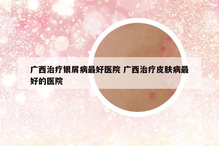 广西治疗银屑病最好医院 广西治疗皮肤病最好的医院