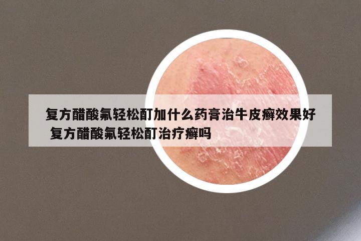 复方醋酸氟轻松酊加什么药膏治牛皮癣效果好 复方醋酸氟轻松酊治疗癣吗