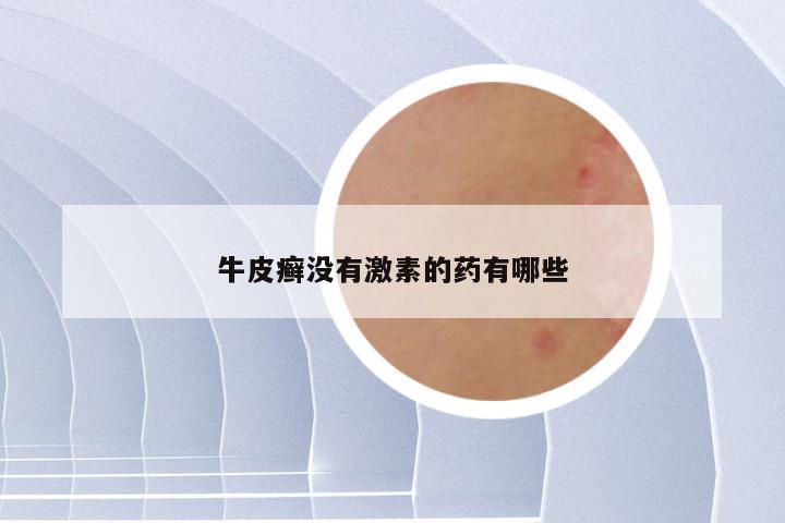 牛皮癣没有激素的药有哪些