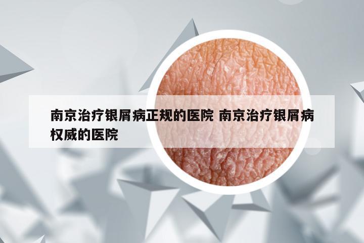 南京治疗银屑病正规的医院 南京治疗银屑病权威的医院