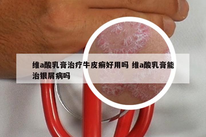 维a酸乳膏治疗牛皮癣好用吗 维a酸乳膏能治银屑病吗