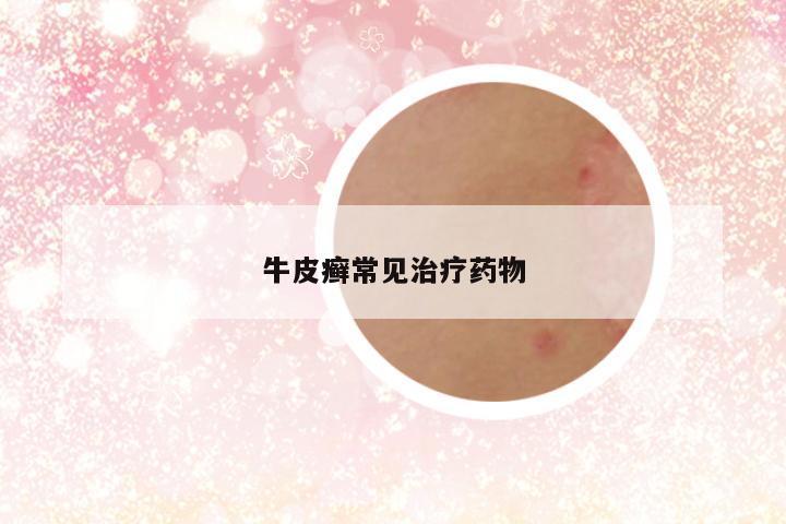 牛皮癣常见治疗药物