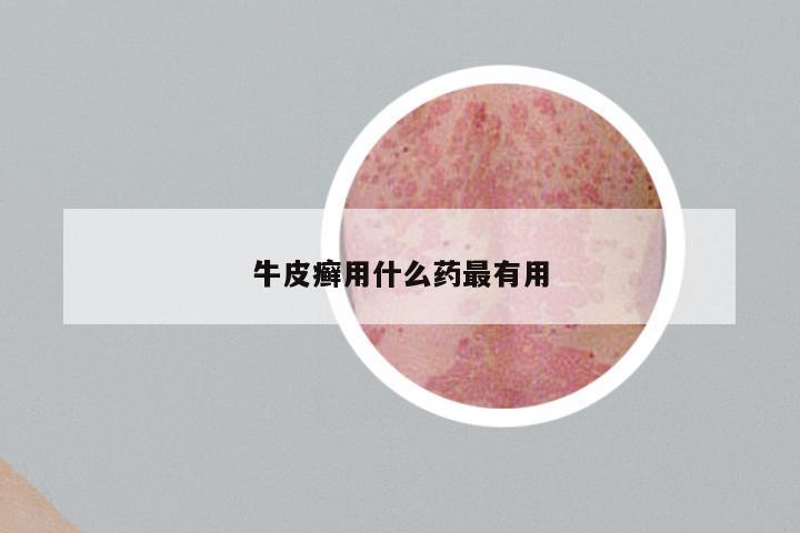 牛皮癣用什么药最有用