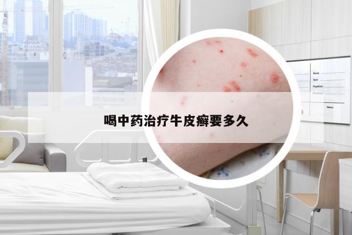 喝中药治疗牛皮癣要多久