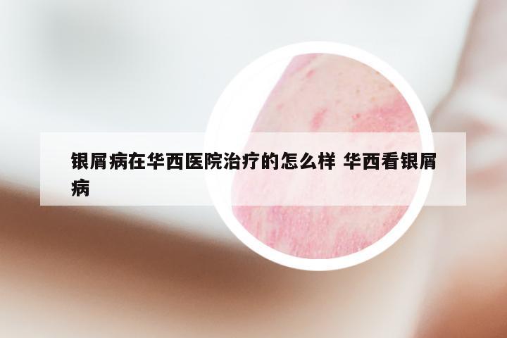 银屑病在华西医院治疗的怎么样 华西看银屑病