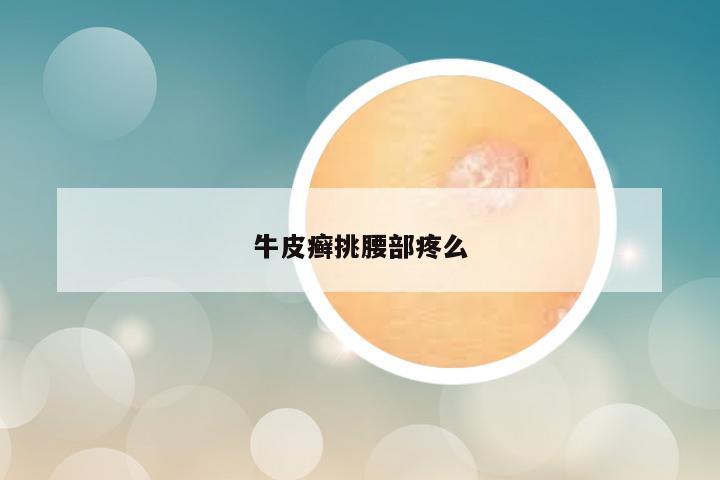 牛皮癣挑腰部疼么