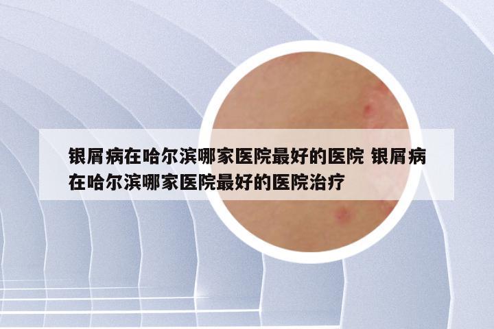 银屑病在哈尔滨哪家医院最好的医院 银屑病在哈尔滨哪家医院最好的医院治疗