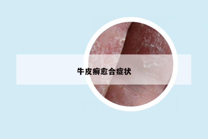 牛皮癣愈合症状