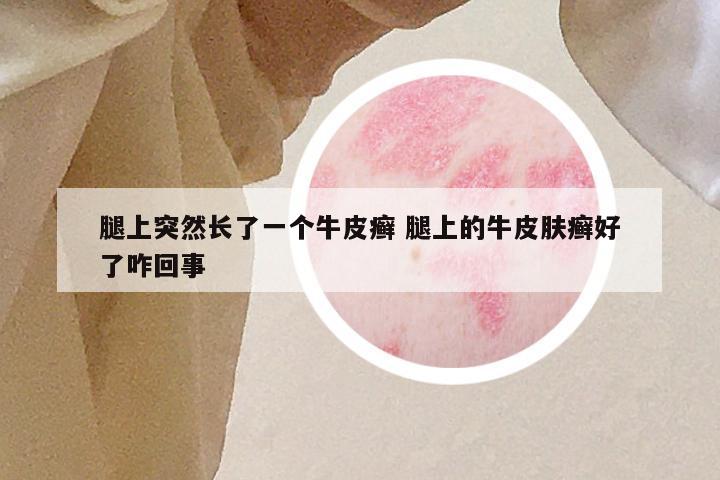 腿上突然长了一个牛皮癣 腿上的牛皮肤癣好了咋回事