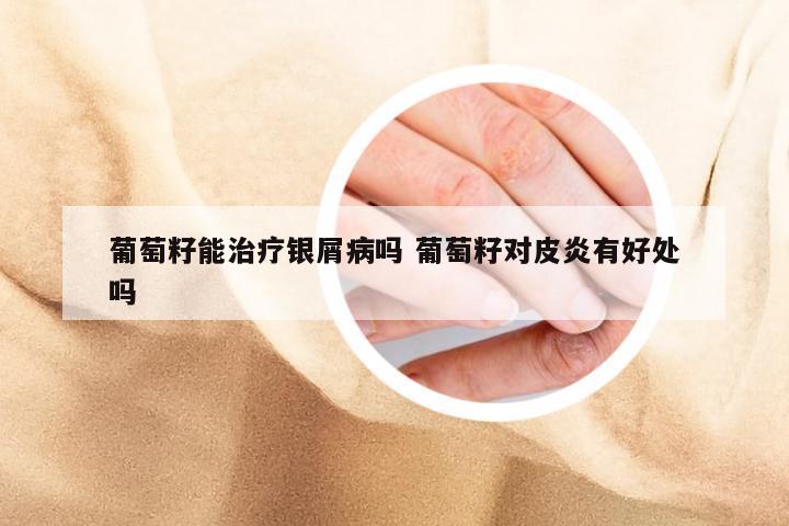 葡萄籽能治疗银屑病吗 葡萄籽对皮炎有好处吗