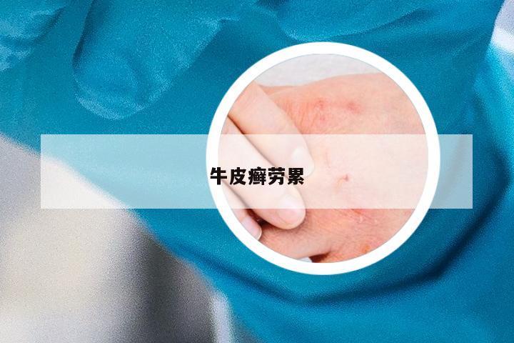 牛皮癣劳累
