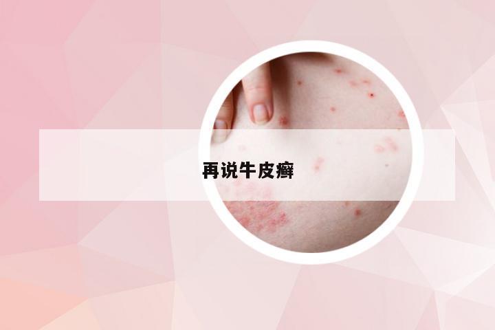 再说牛皮癣