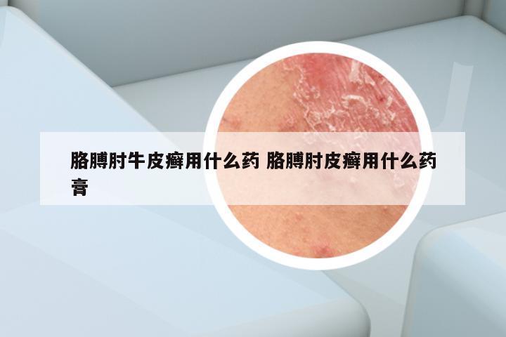 胳膊肘牛皮癣用什么药 胳膊肘皮癣用什么药膏
