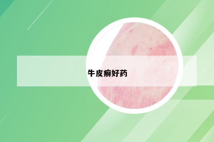 牛皮癣好药