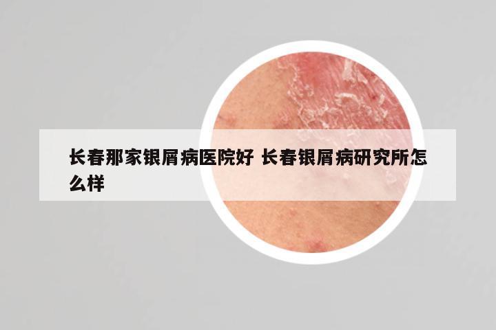 长春那家银屑病医院好 长春银屑病研究所怎么样