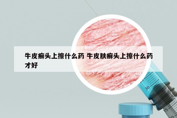 牛皮癣头上擦什么药 牛皮肤癣头上擦什么药才好