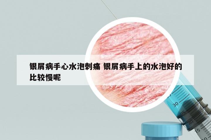 银屑病手心水泡刺痛 银屑病手上的水泡好的比较慢呢