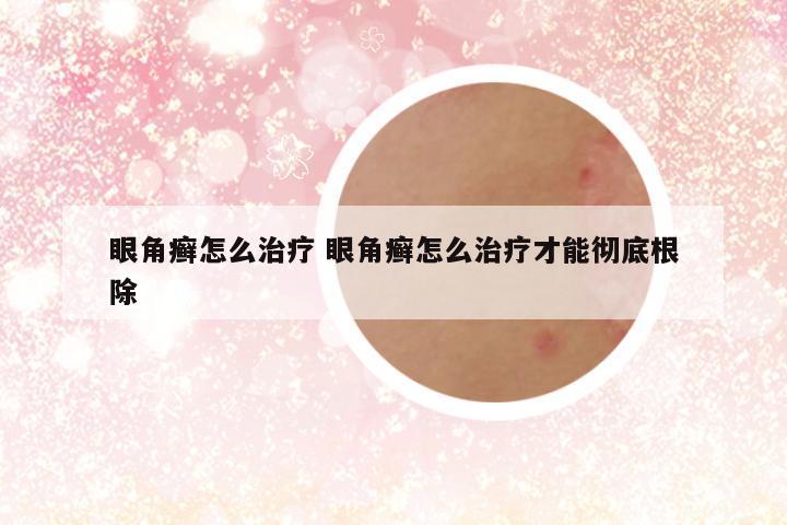 眼角癣怎么治疗 眼角癣怎么治疗才能彻底根除