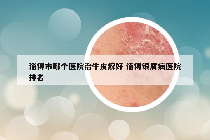 淄博市哪个医院治牛皮癣好 淄博银屑病医院排名