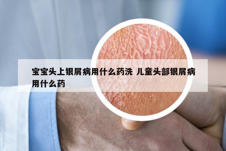 宝宝头上银屑病用什么药洗 儿童头部银屑病用什么药