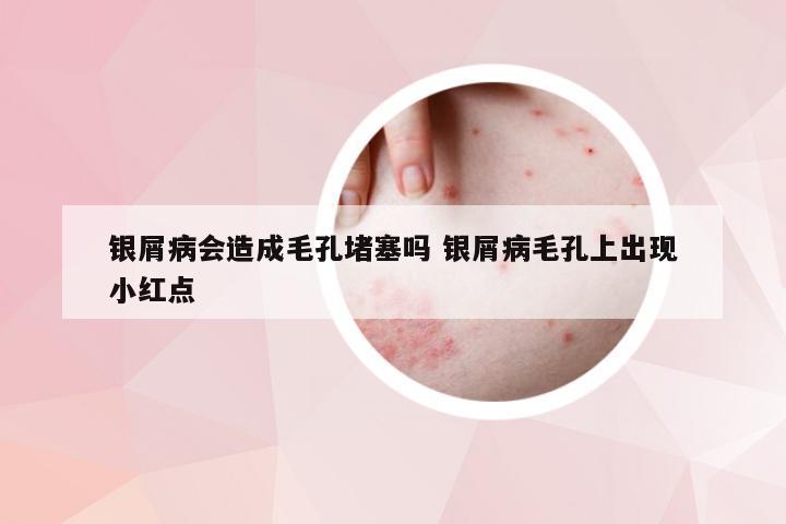 银屑病会造成毛孔堵塞吗 银屑病毛孔上出现小红点