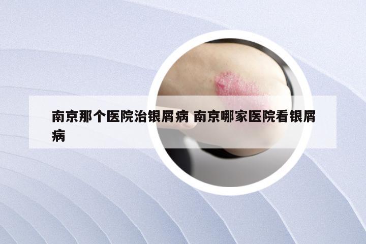 南京那个医院治银屑病 南京哪家医院看银屑病