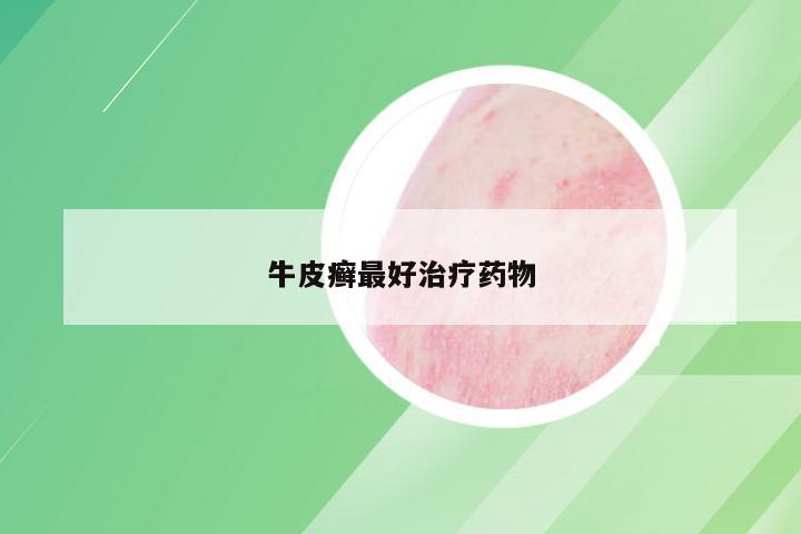 牛皮癣最好治疗药物