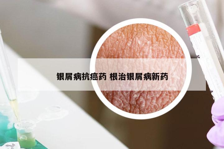 银屑病抗癌药 根治银屑病新药