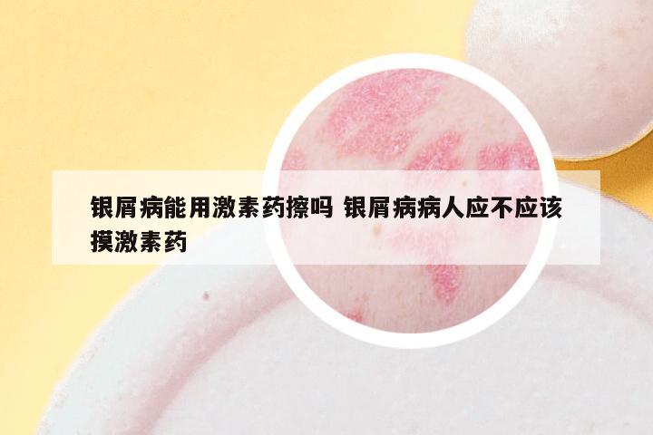银屑病能用激素药擦吗 银屑病病人应不应该摸激素药