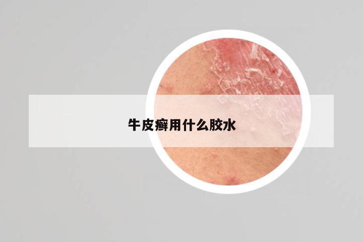 牛皮癣用什么胶水