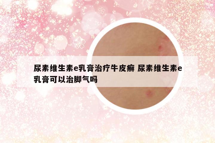 尿素维生素e乳膏治疗牛皮癣 尿素维生素e乳膏可以治脚气吗