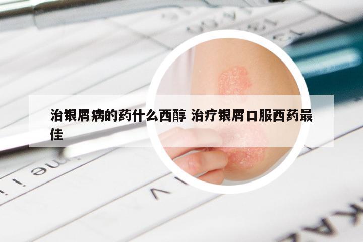 治银屑病的药什么西醇 治疗银屑口服西药最佳