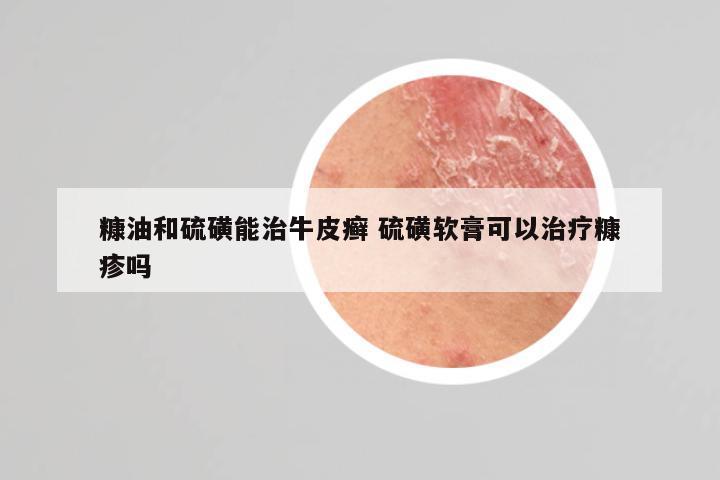 糠油和硫磺能治牛皮癣 硫磺软膏可以治疗糠疹吗