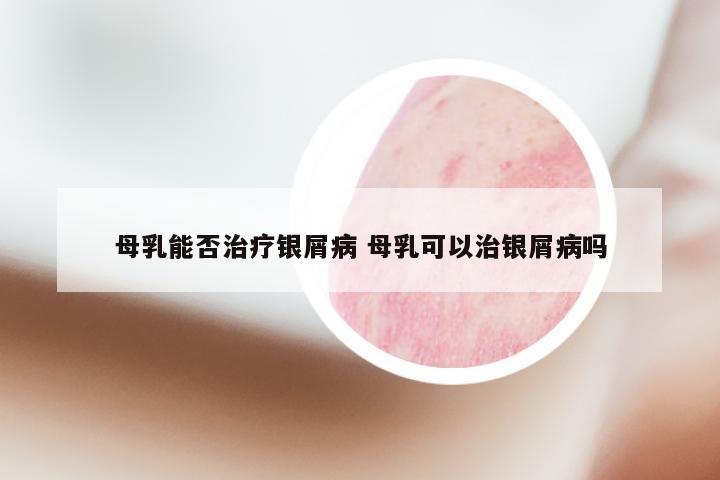 母乳能否治疗银屑病 母乳可以治银屑病吗