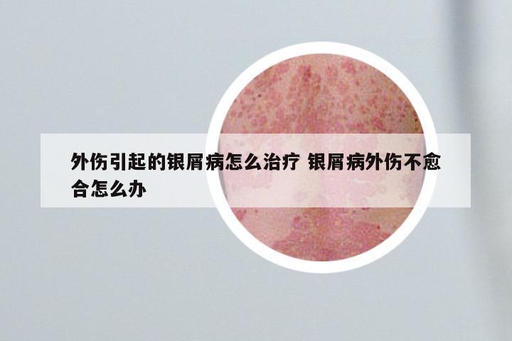 外伤引起的银屑病怎么治疗 银屑病外伤不愈合怎么办