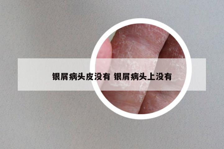 银屑病头皮没有 银屑病头上没有