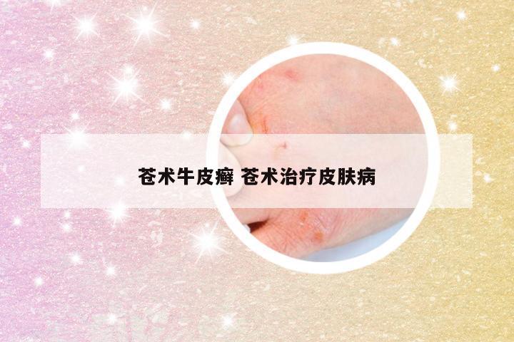 苍术牛皮癣 苍术治疗皮肤病