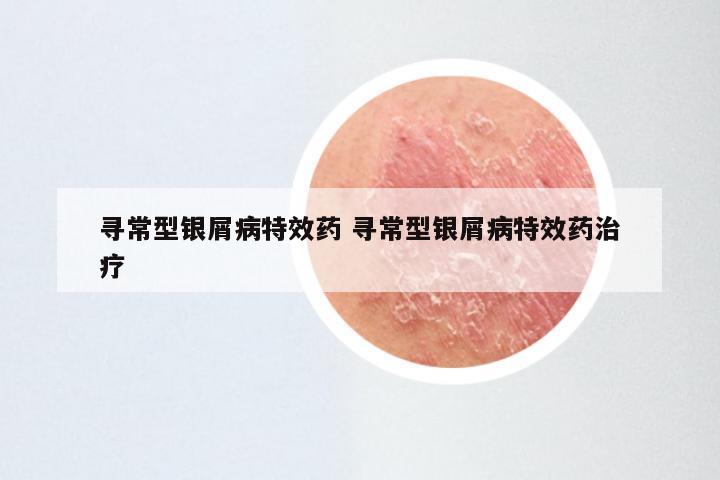 寻常型银屑病特效药 寻常型银屑病特效药治疗