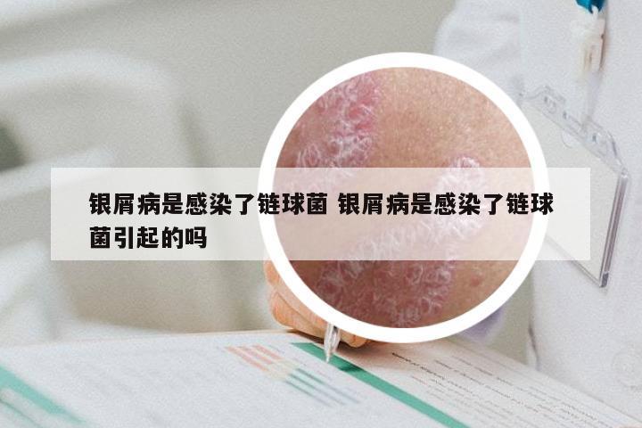 银屑病是感染了链球菌 银屑病是感染了链球菌引起的吗