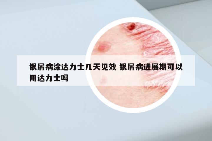 银屑病涂达力士几天见效 银屑病进展期可以用达力士吗