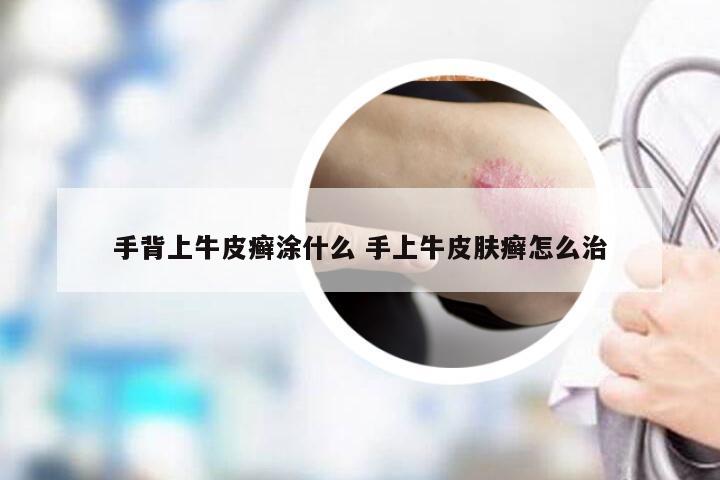 手背上牛皮癣涂什么 手上牛皮肤癣怎么治