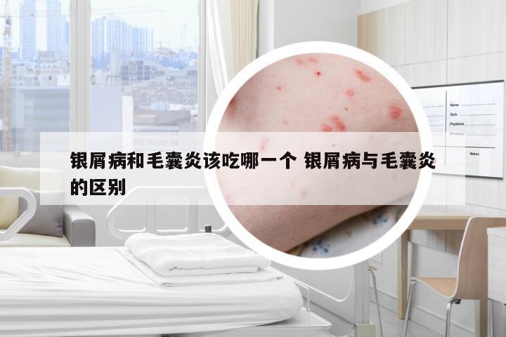 银屑病和毛囊炎该吃哪一个 银屑病与毛囊炎的区别