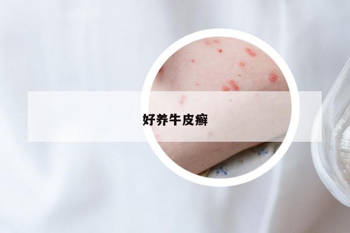好养牛皮癣
