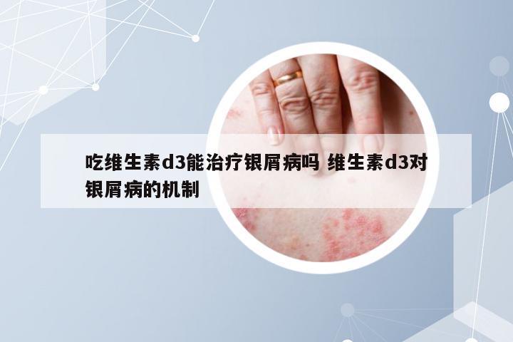 吃维生素d3能治疗银屑病吗 维生素d3对银屑病的机制