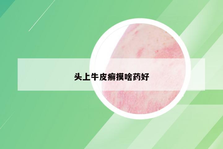 头上牛皮癣摸啥药好