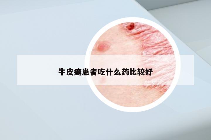 牛皮癣患者吃什么药比较好